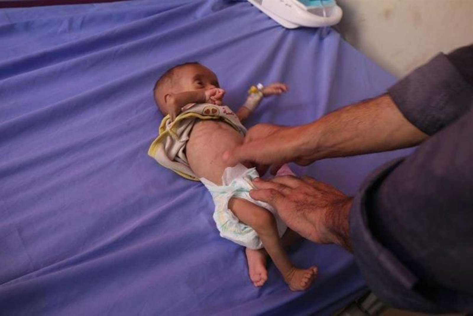 Un bebé con desnutrición es atendido en un hospital de la ciudad de Gaza, en medio de la ofensiva del Ejército de Israel contra la Franja de Gaza