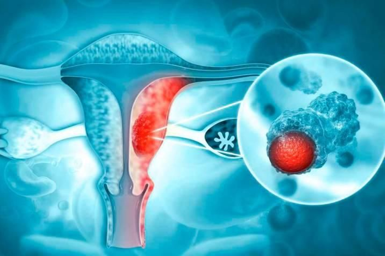 Cáncer de cuello uterino.