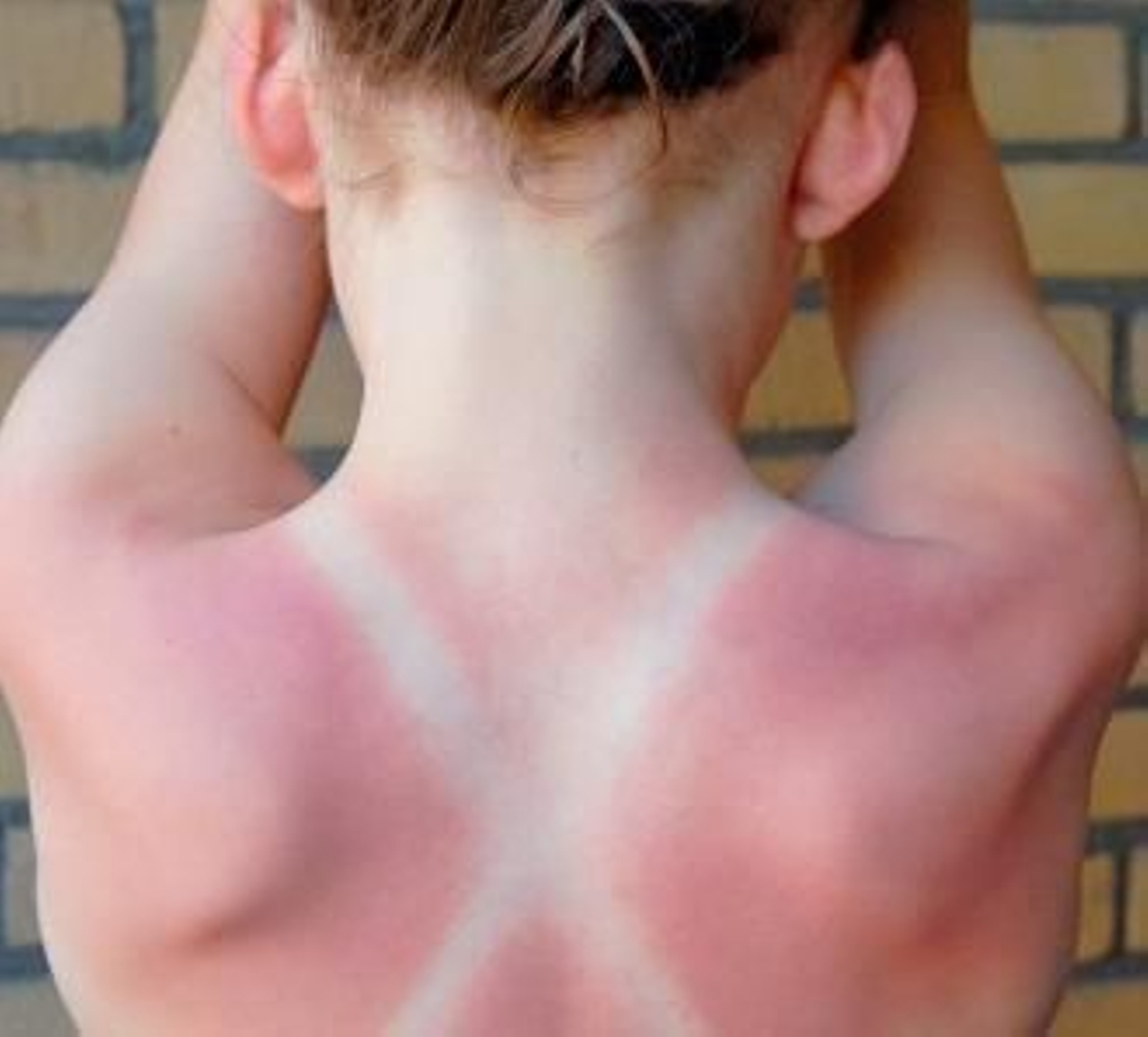 La espalda de una niña quemada.