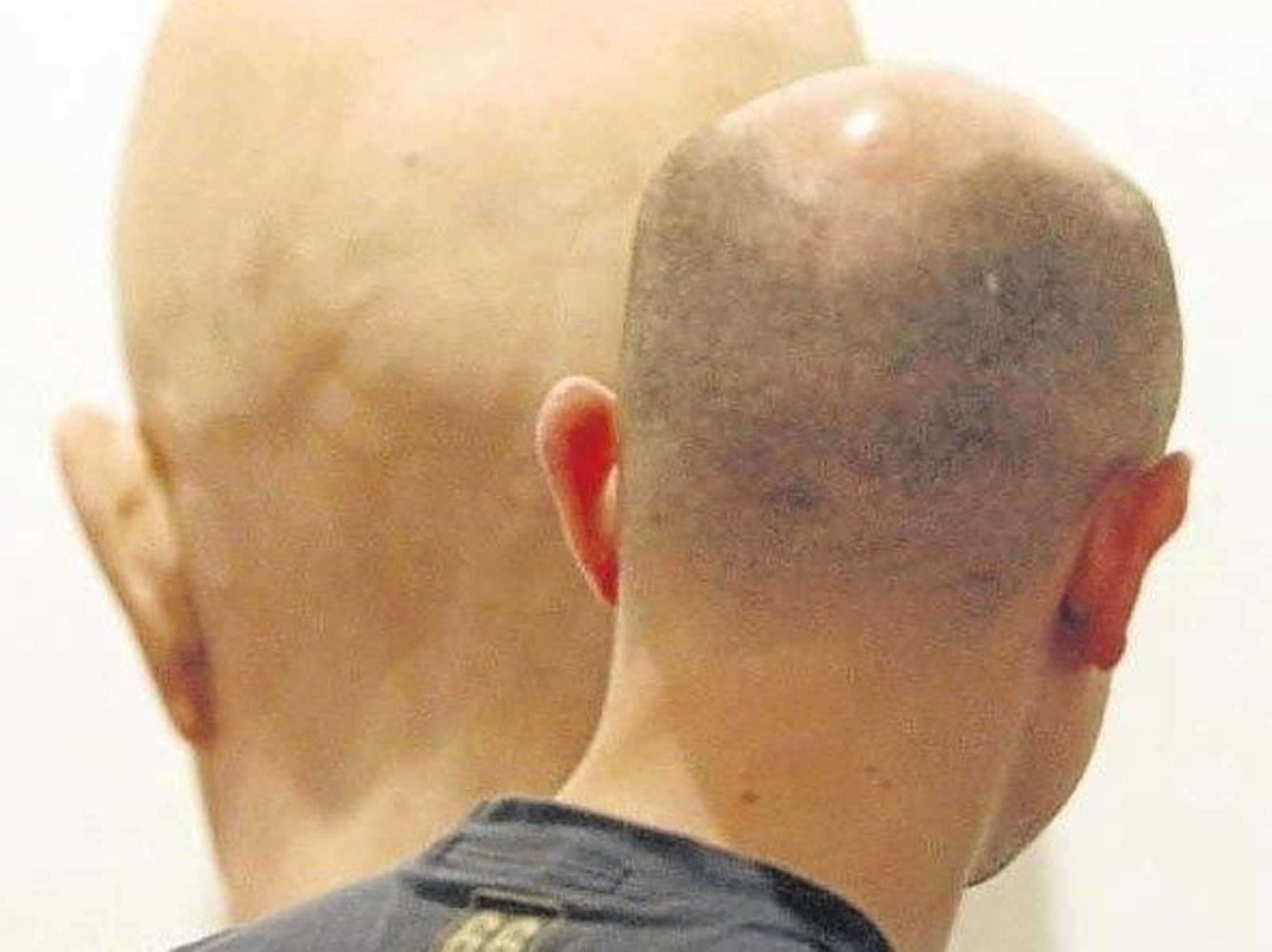 Un joven con alopecia.