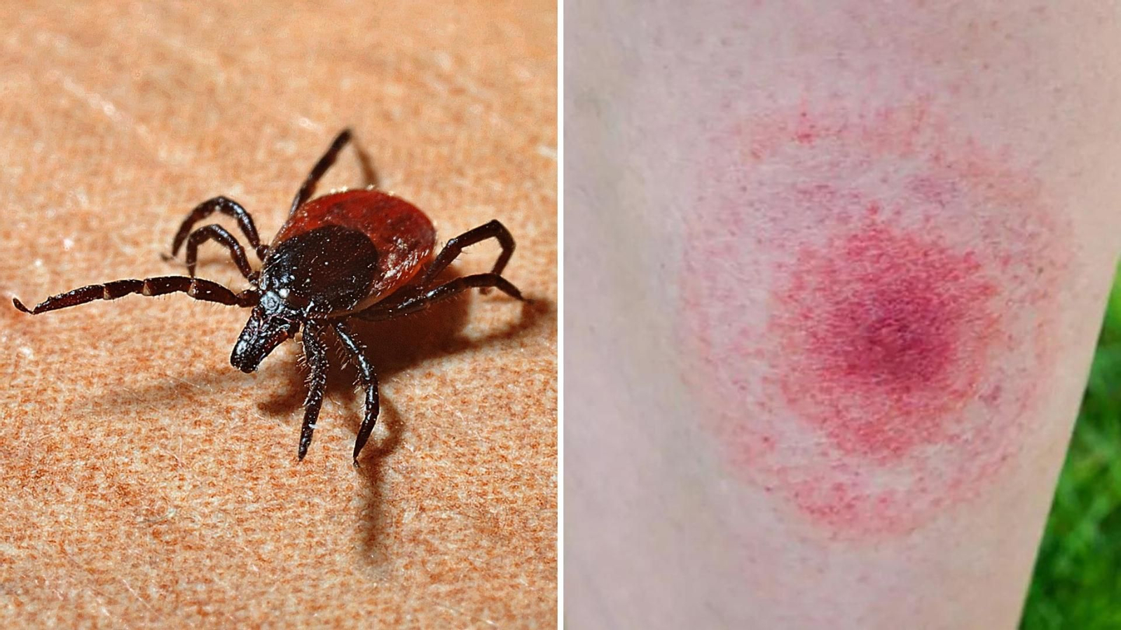 La garrapata provoca la enfermedad del lyme.