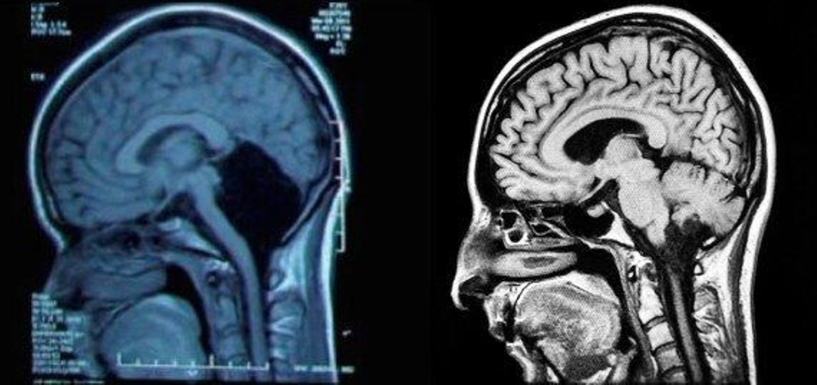 Comparativa entre el cerebro de la joven china (izquierda) y un cerebro normal. (FENG YU)