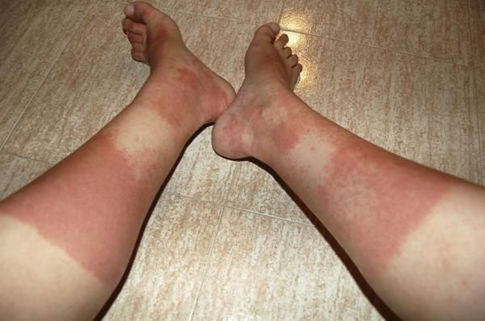 Una de las afectadas por el calzado chino muestra sus piernas, (Foto: EFE)