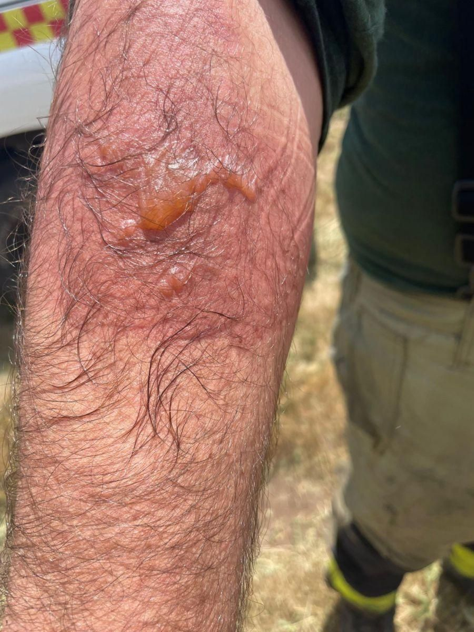 Estado en el que quedó el brazo del bombero herido.