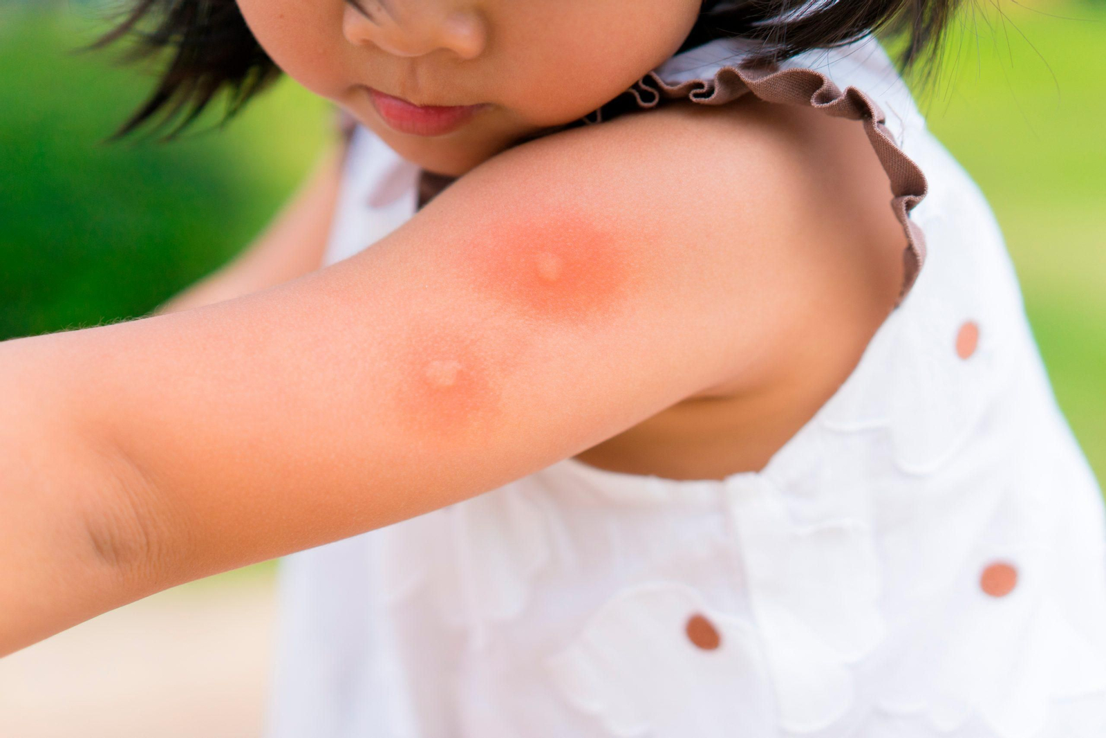 Picaduras de mosquito
