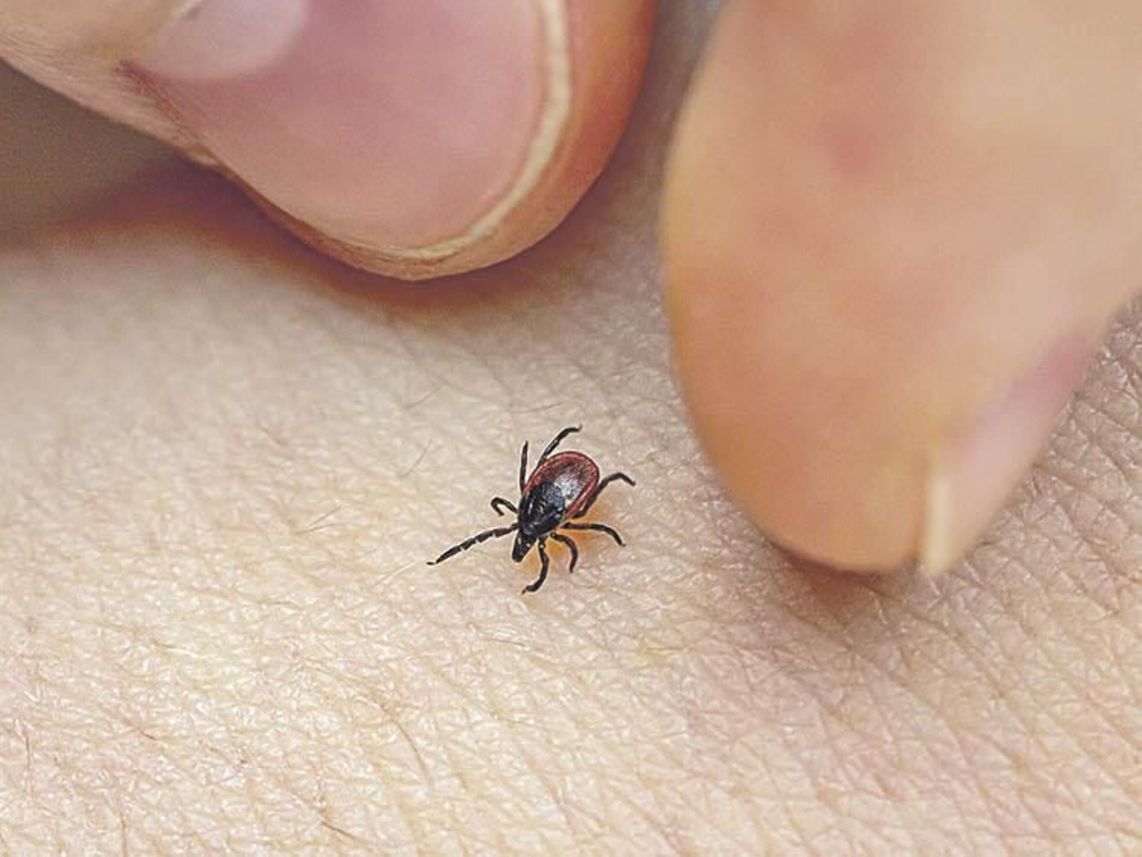 Una persona intenta quitarse una garrapata de la piel.