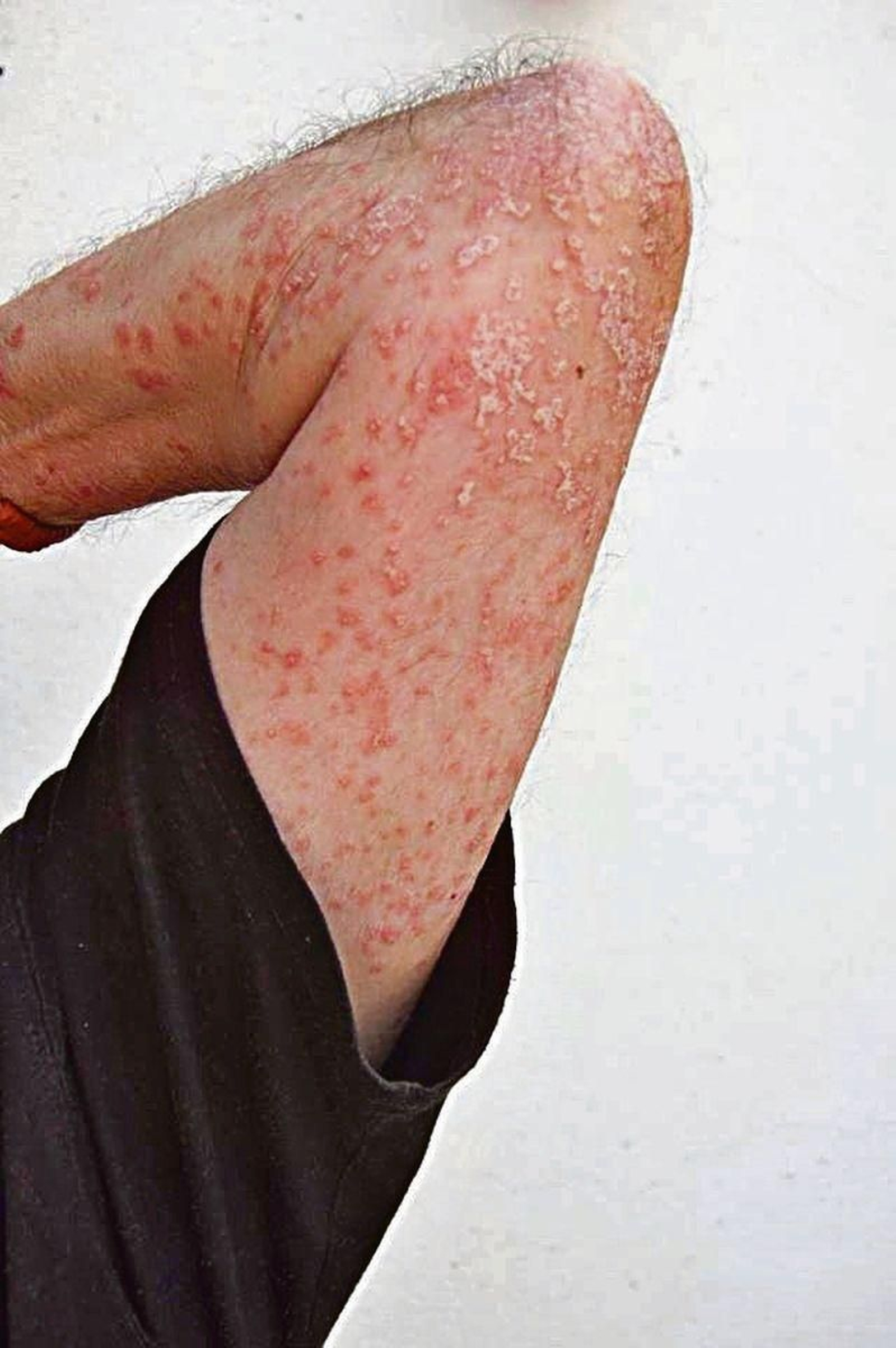 Paciente que presenta psoriasis en el brazo.