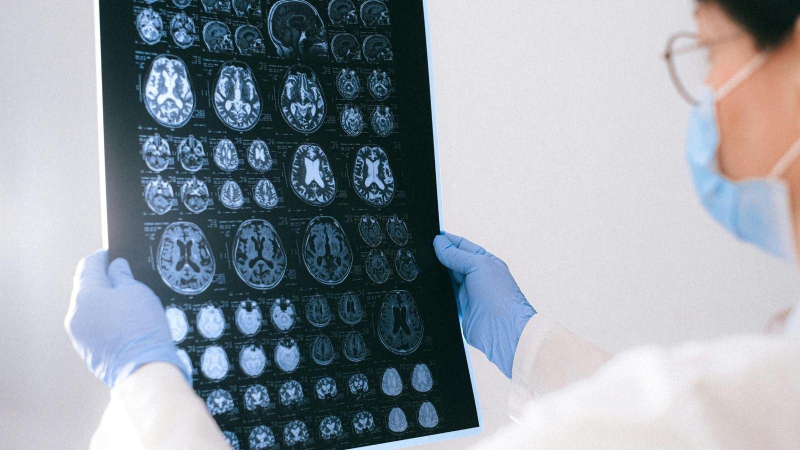Una doctora estudia una radiografía cerebral.