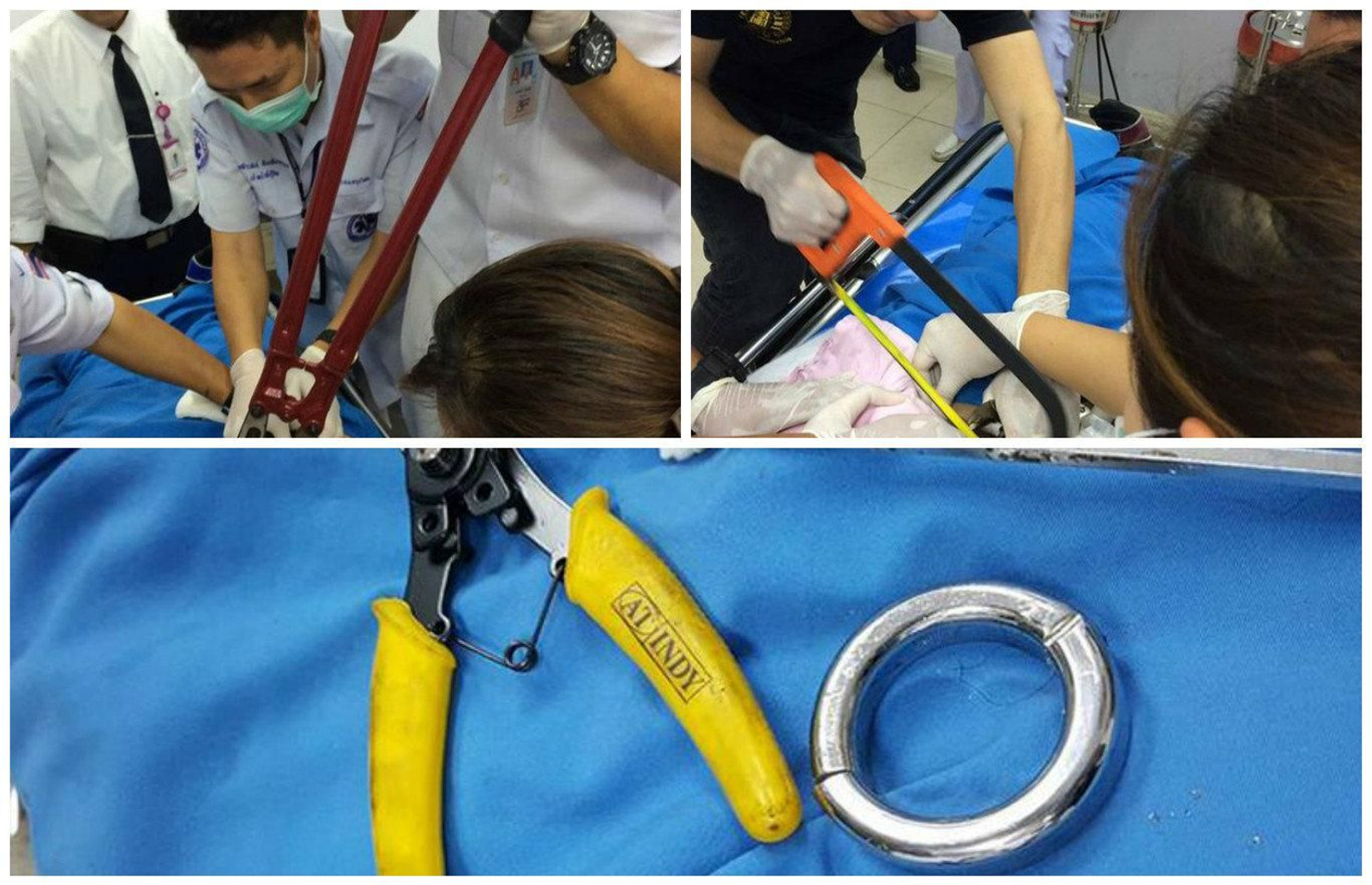 En primer plano el anillo metálico utilizado por el hombre. En las dos fotografías superiores utilizando herramientas para sacar el anillo del pene del afectado.