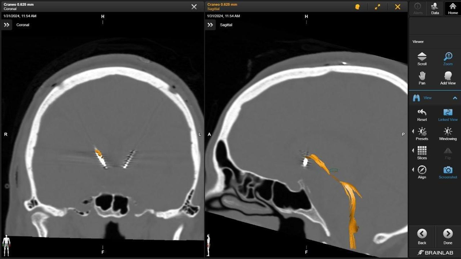 Así se veía el cráneo del paciente con TOC.