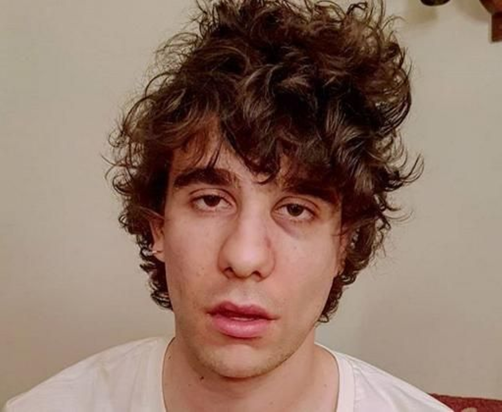 El actor y director Javier Calvo compartió una foto en la que se aprecian las consecuencias del puñetazo recibido.