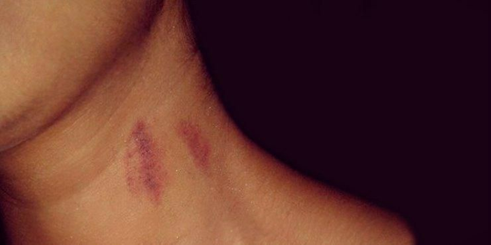 Imagen de un chupetón en el cuello.
