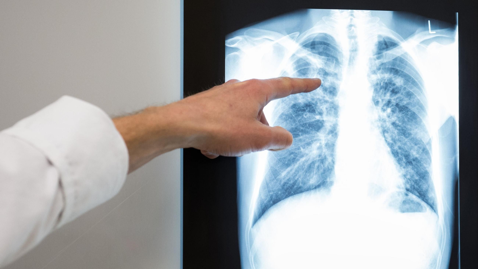 Radiografía de unos pulmones.