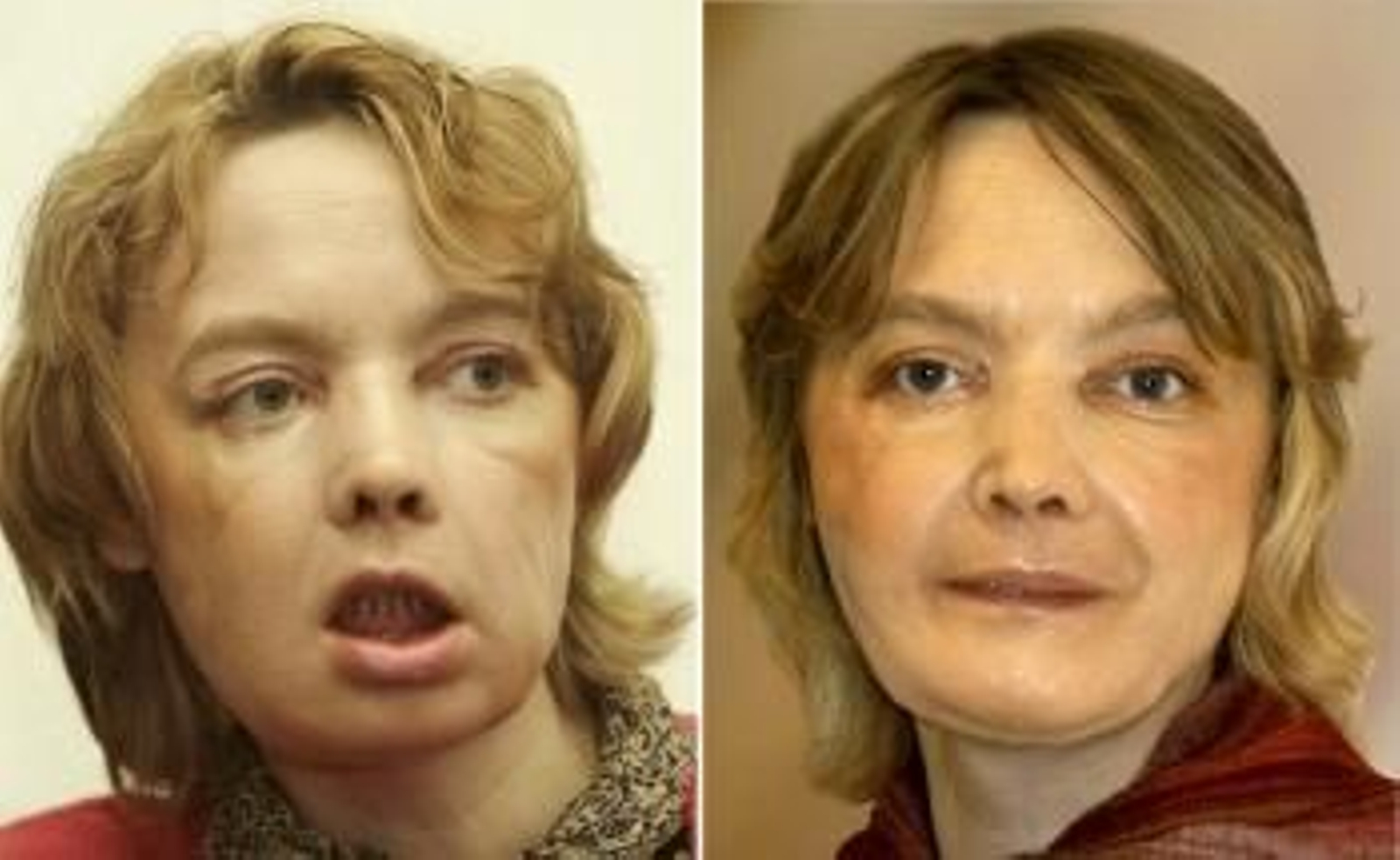 Imagen de antes y después del trasplante de cara a la francesa a la que desfiguró un perro. (Foto: Archivo)
