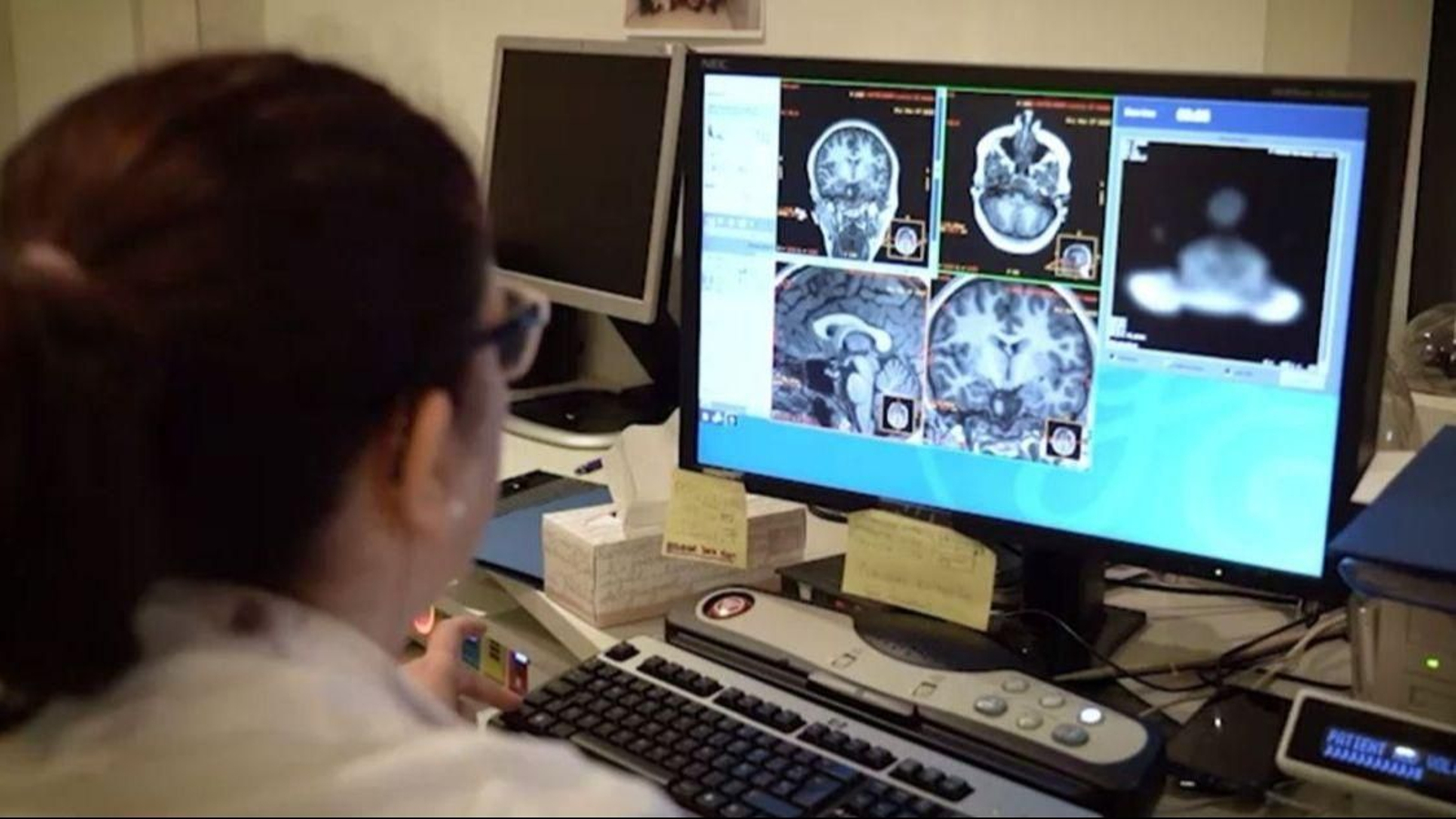 Una neuróloga estudia los daños del alzhéimer en una persona.