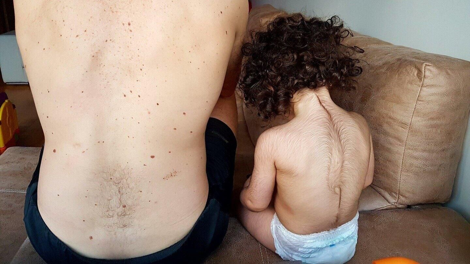 Un niño afectado de hipertricosis. // EP