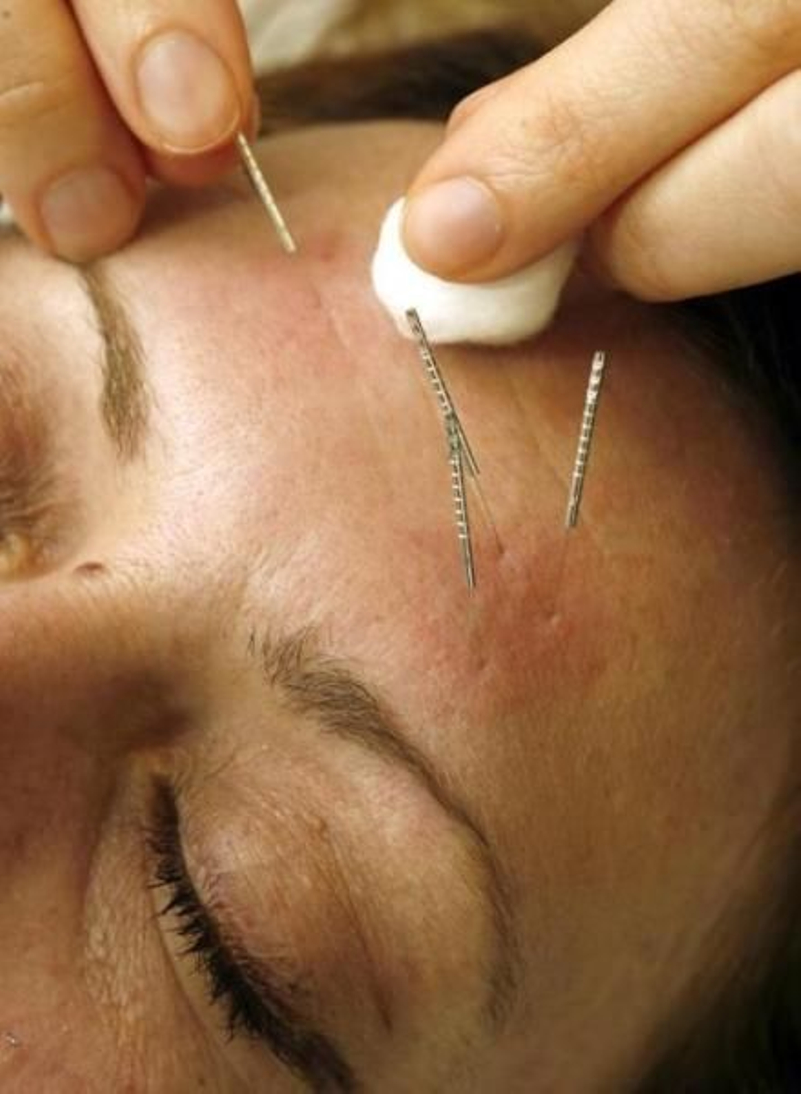 Una mujer recibe un tratamiento de acupuntura.