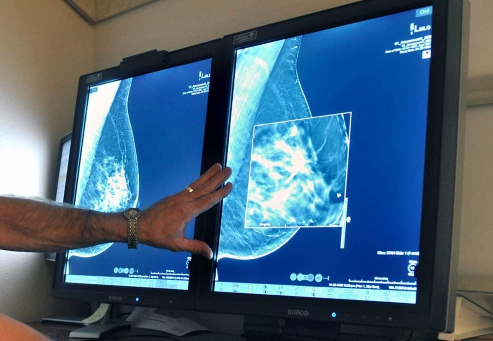 Un especialista muestra imágenes de un pecho afectado por cáncer.