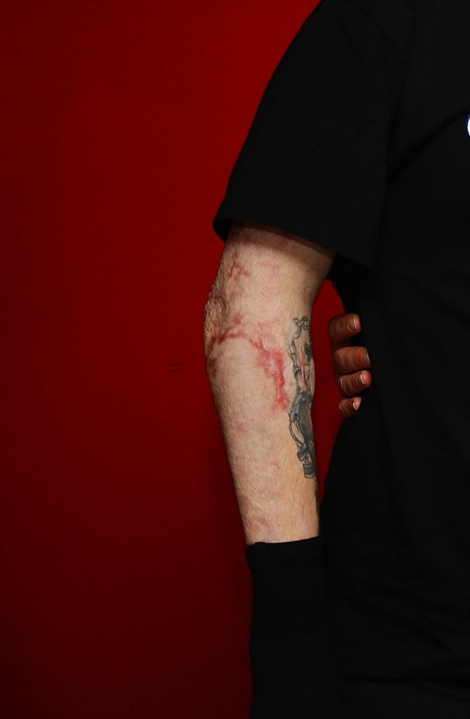 Tatuaje en el brazo quemado de Yago que se había hecho semanas antes del accidente. Ahora afirma que cuando tenga su piel curada se hará varios tatuajes nuevos.