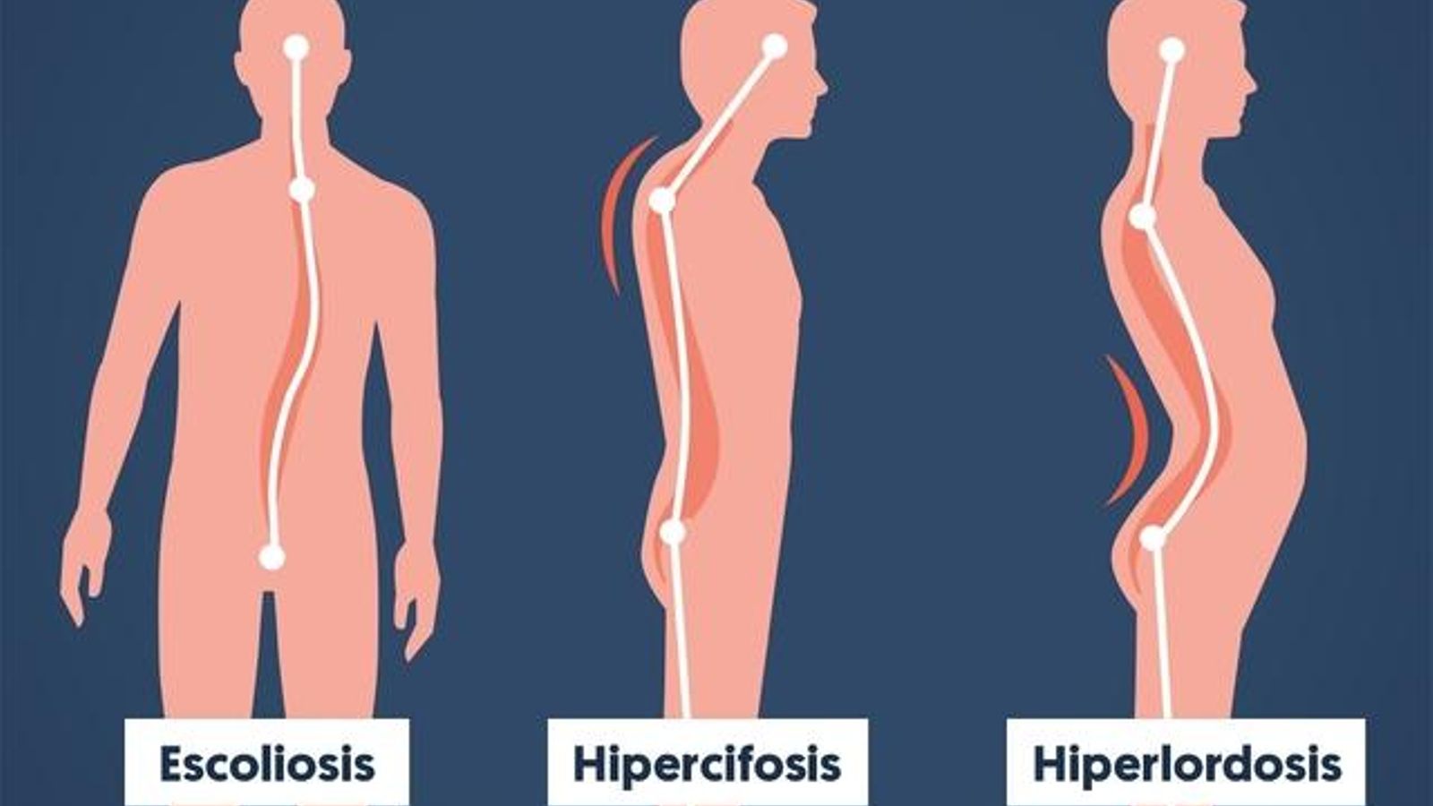 La hiperlordosis provoca una curvatura en la parte baja de la espalda.