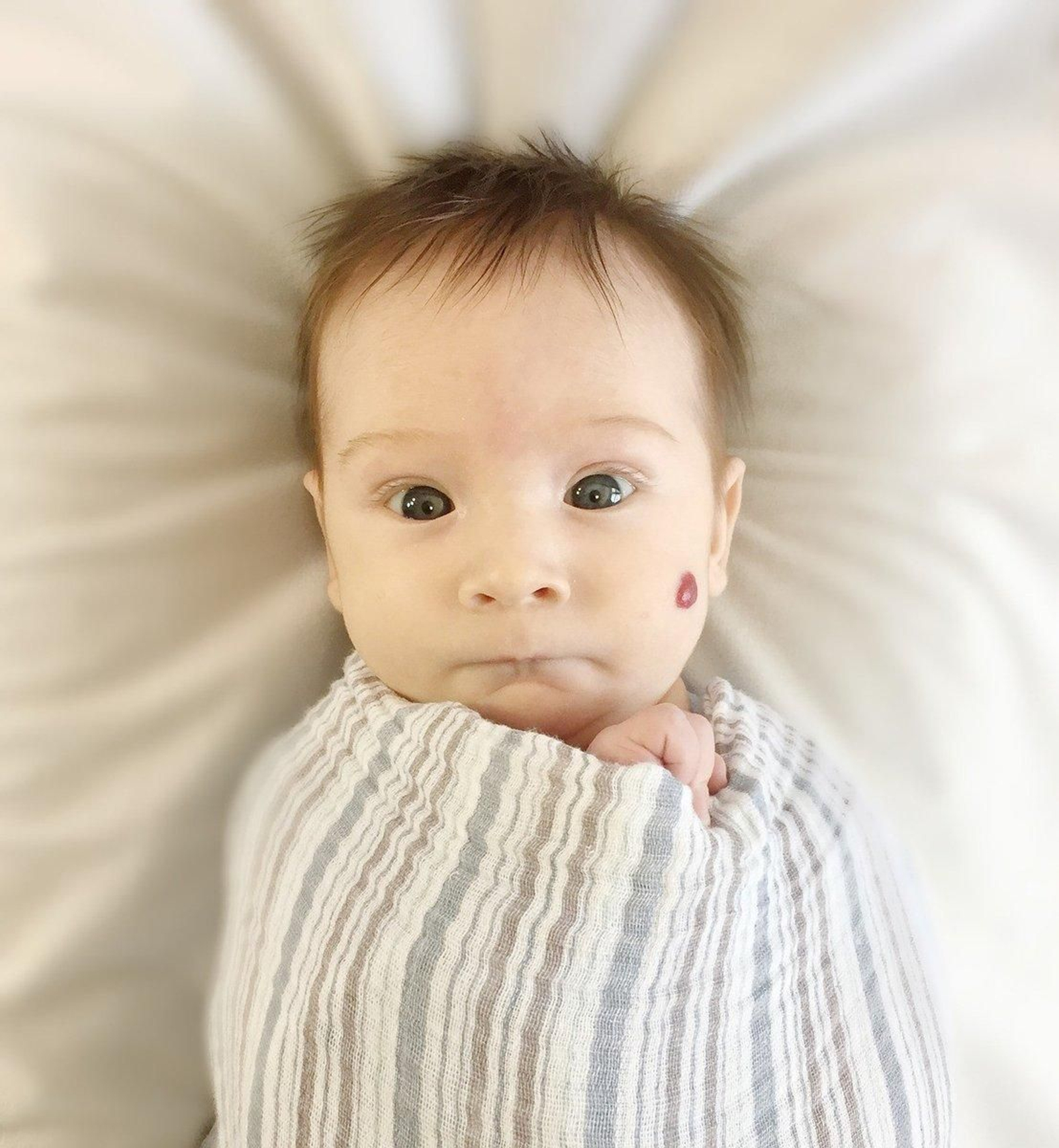 Los hemangiomas son muy comunes en los bebés.