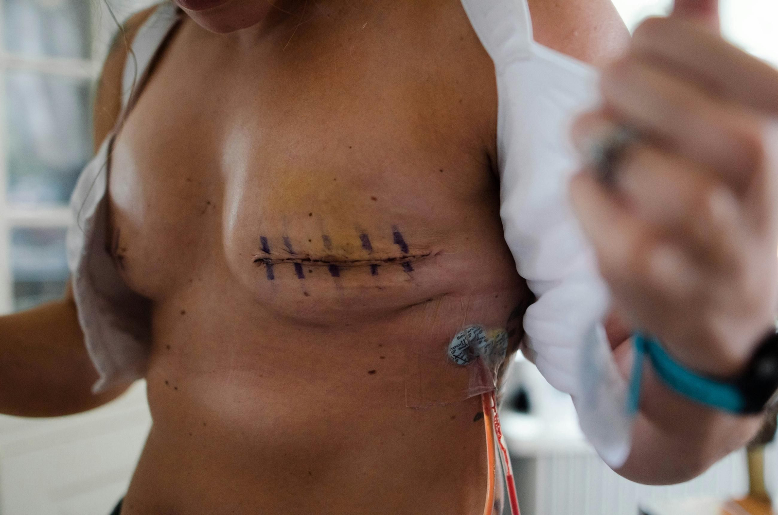 Cicatriz de una paciente de cáncer de mama.